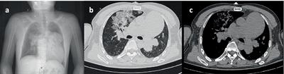 A case report of severe pneumonia caused by Aeromonas dhakensis infection complicated with severe atrial septal defect